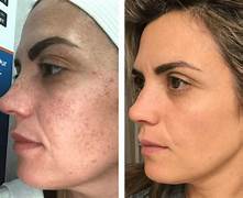 Rajeunissement de la Peau IPL — Après