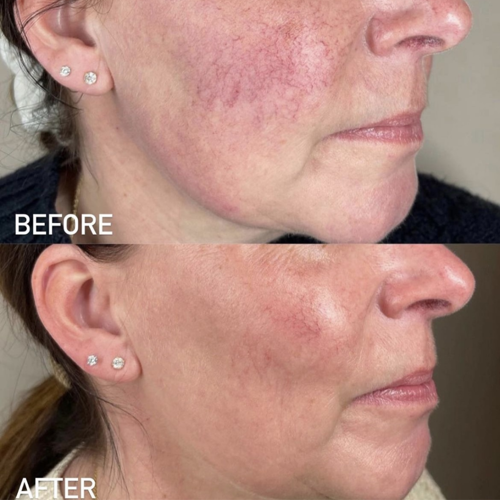 Rajeunissement de la Peau IPL — Avant