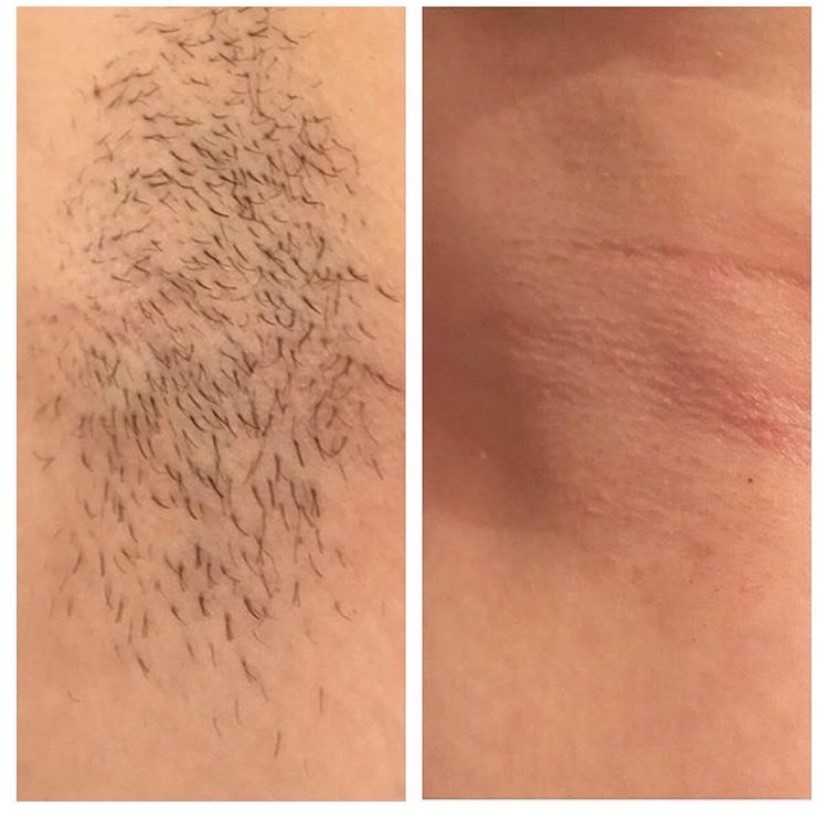 Épilation au Laser — Après