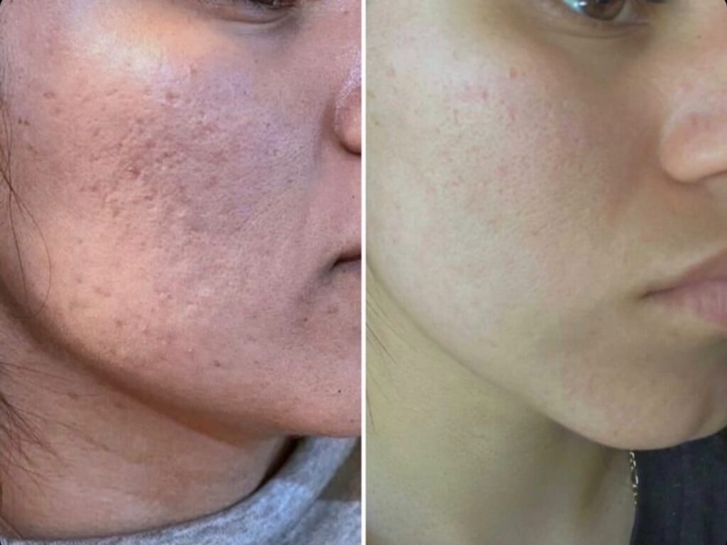 Microneedling — Après